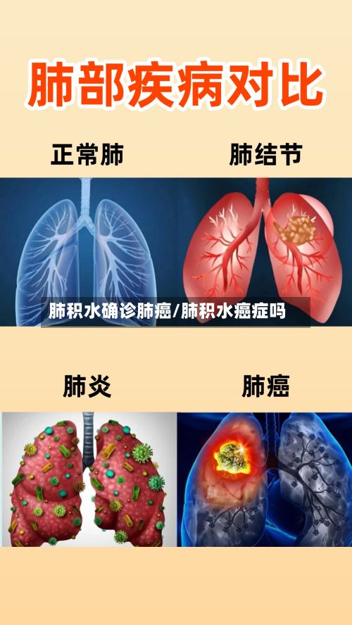 肺积水确诊肺癌/肺积水癌症吗
